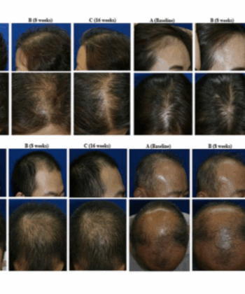 Hair Loss Solution | A-SCAL Exosome Stem Cell 3ml x 5 for Scalp & Hair Regeneration - Image 2