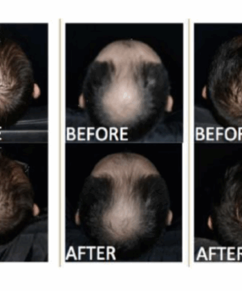 Hair Loss Solution | A-SCAL Exosome Stem Cell 3ml x 5 for Scalp & Hair Regeneration - Image 6