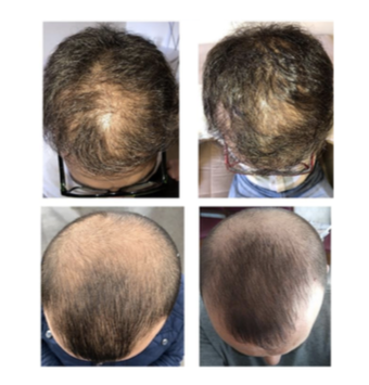 Hair Loss Solution | A-SCAL Exosome Stem Cell 3ml x 5 for Scalp & Hair Regeneration - Image 7